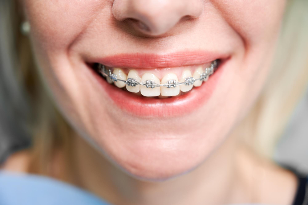 Aparaty Ortodontyczne: Uśmiech na Każdy Dzień